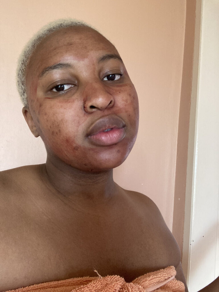 Image of Lady shares results of rubbing her period blood on her face